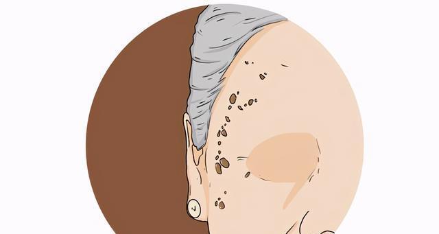 快速祛除老年斑的有效方法(教你简单又快速消除老年斑的养肤秘诀) 第2张 快速祛除老年斑的有效方法(教你简单又快速消除老年斑的养肤秘诀) 第2张